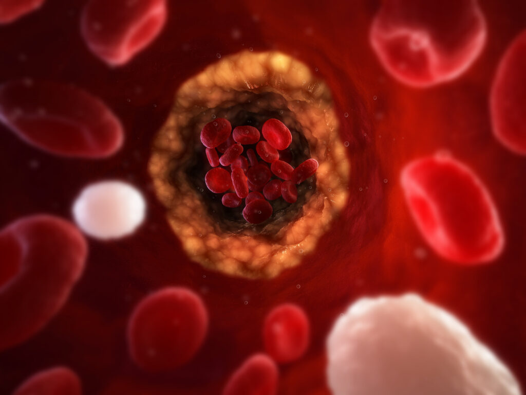 Narrowed artery partially blocked